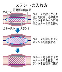ステントの入れ方